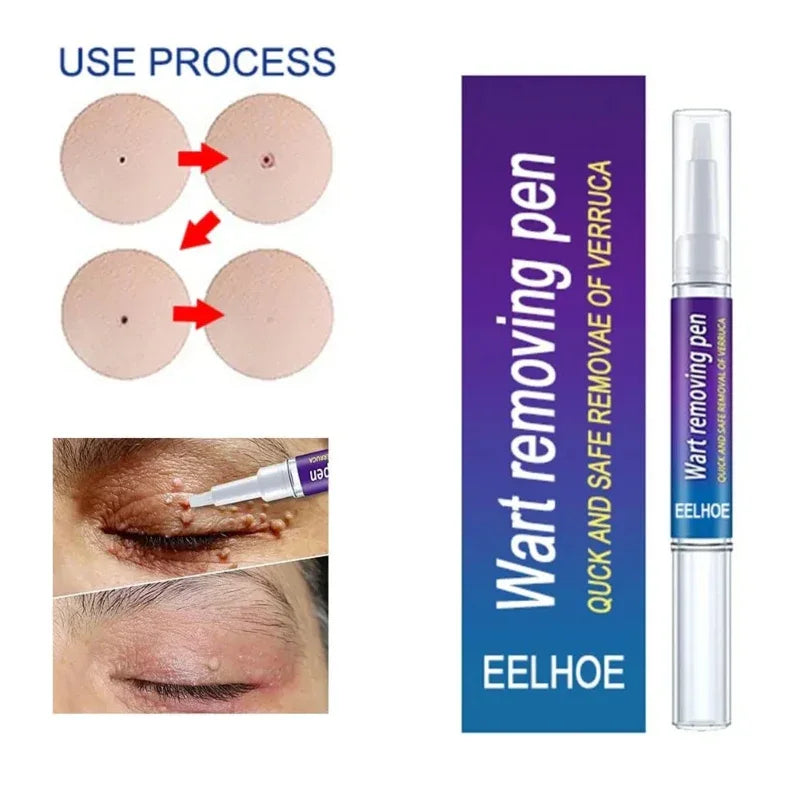 Warts Liquid Pen Woman Skin moles Remove Black Dots - Prozone