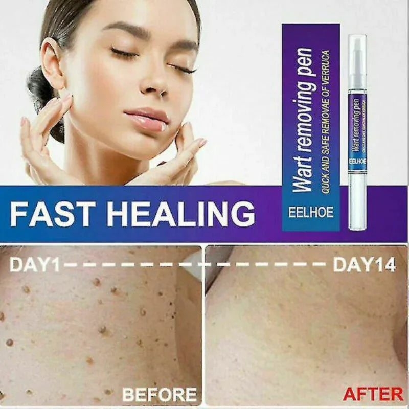 Warts Liquid Pen Woman Skin moles Remove Black Dots - Prozone