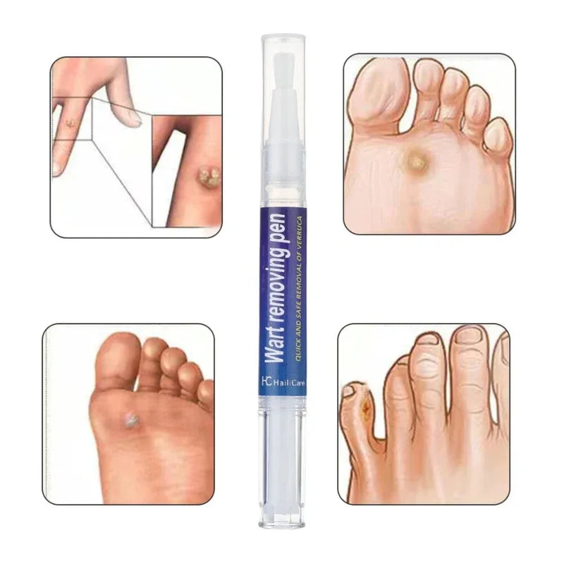 Warts Liquid Pen Woman Skin moles Remove Black Dots - Prozone