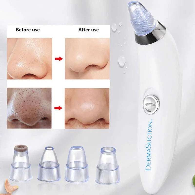Derma suction cell operated black head remover - Prozone