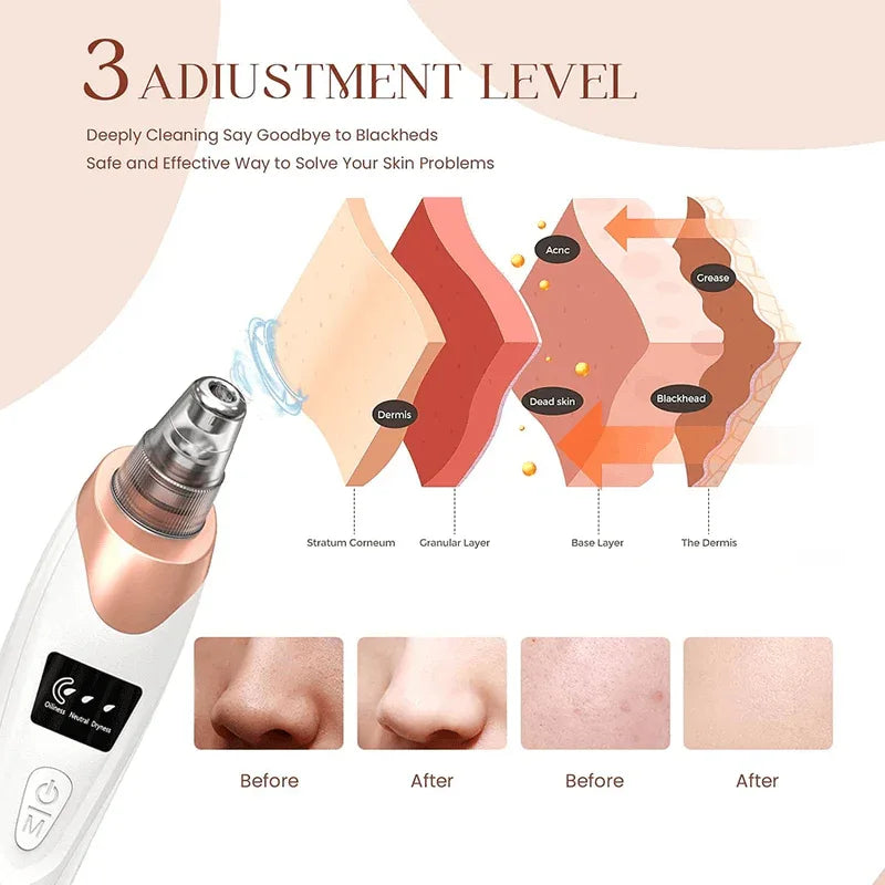 Newest blackhead remover pore vacuum - Prozone
