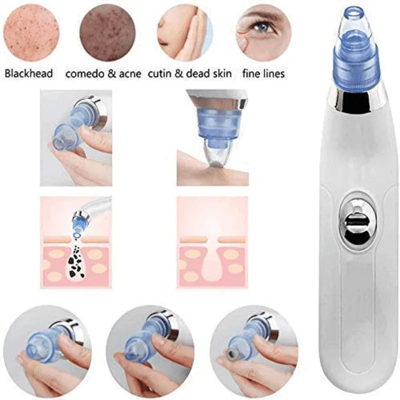 Derma suction cell operated black head remover - Prozone