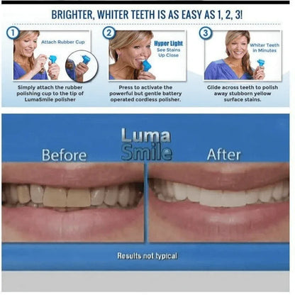 Dental teeth whitener- teeth stain remover - Prozone