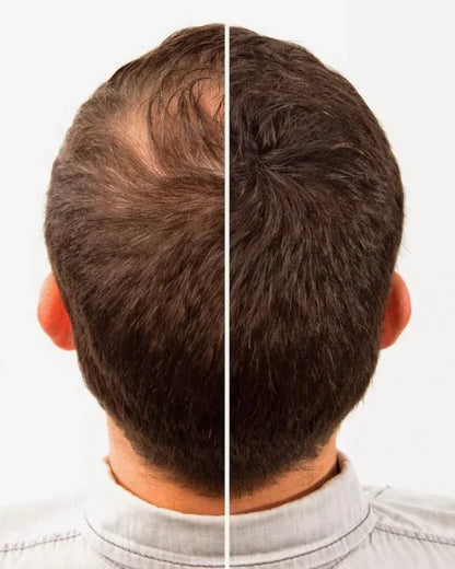 Caboki hair fiber - Prozone