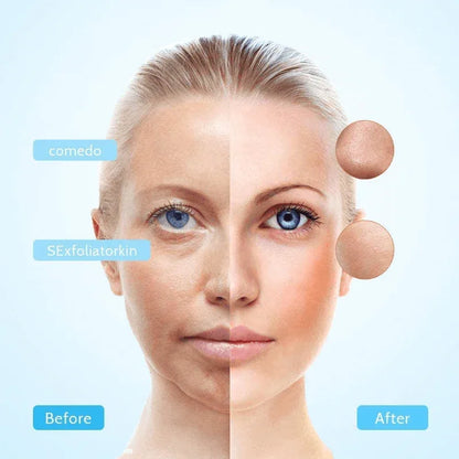 Electric suction blackhead remover pore cleanser - Prozone
