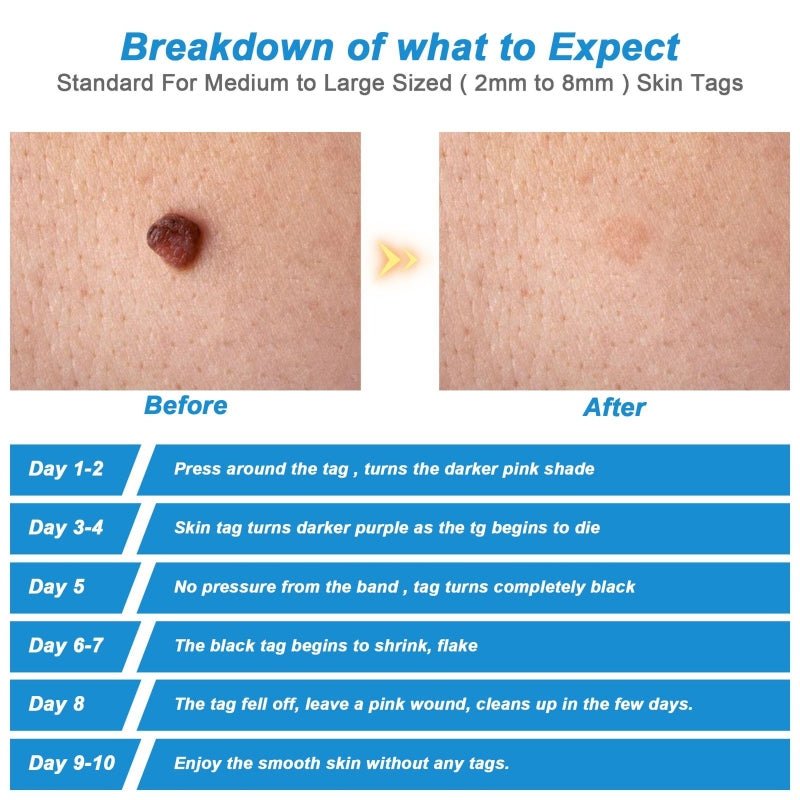 Skin Tag Remover - Prozone